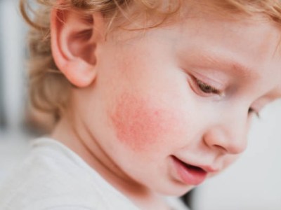 How My Daughter’s “Eczema” Was Actually a Gut Issue (And What Finally Cleared&nbsp;It)